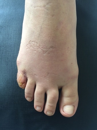 Esadattilia del piede destro prima foto dopo l'intervento